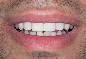 Paradise Before and After Teeth Whitening